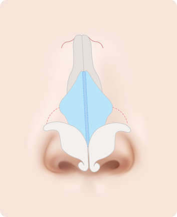 Nose Shape Correction