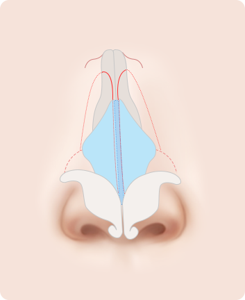 Nose Shape Correction