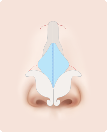 Nose Shape Correction