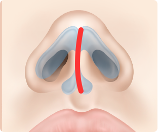 Nose Shape Correction