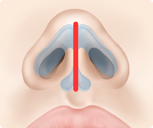 Nose Shape Correction