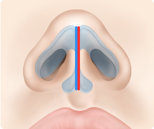 Nose Shape Correction