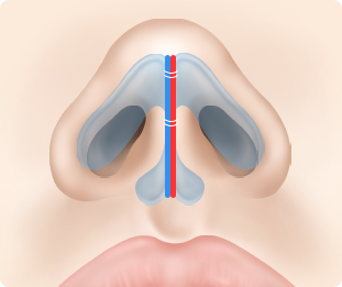 Nose Shape Correction