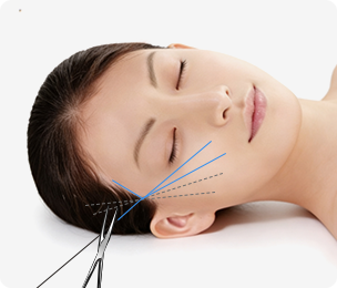 Full-Face Thread lift