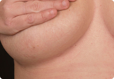 Breast Reduction