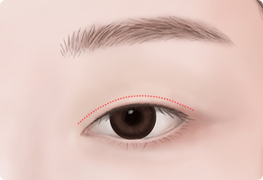 Ptosis Correction