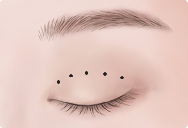 Ptosis Correction