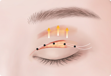 Ptosis Correction