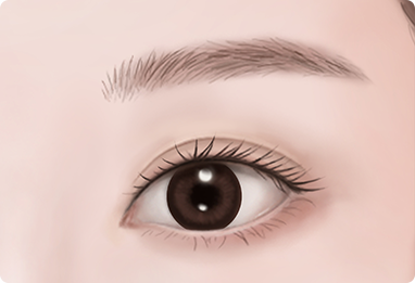 Ptosis Correction