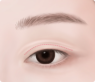 Ptosis Correction