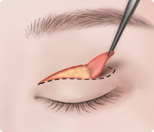 Ptosis Correction