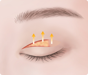 Ptosis Correction