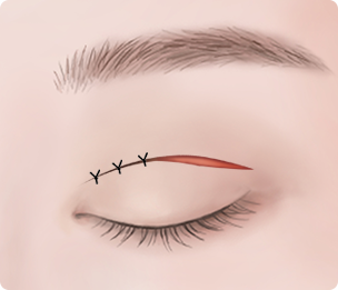 Ptosis Correction