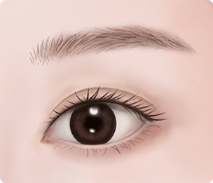 Ptosis Correction