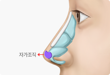 Nose Shape Correction