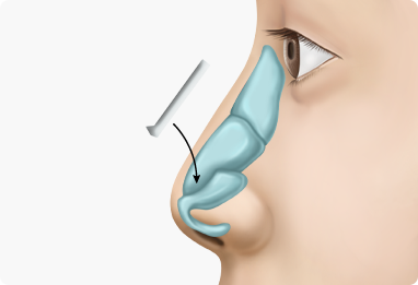 Nose Shape Correction