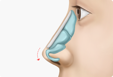 Nose Shape Correction