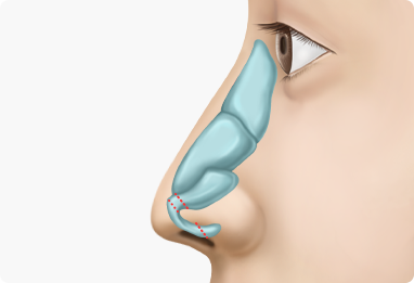 Nose Shape Correction