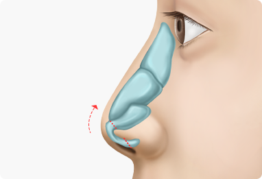 Nose Shape Correction