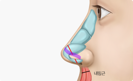 Nose Shape Correction