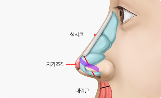 Nose Shape Correction