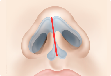 Nose Shape Correction