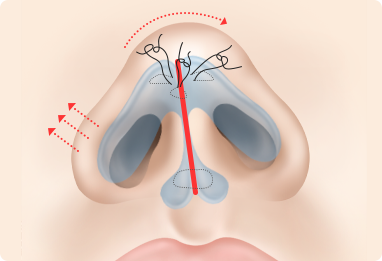 Nose Shape Correction
