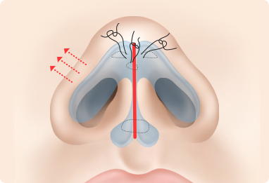 Nose Shape Correction