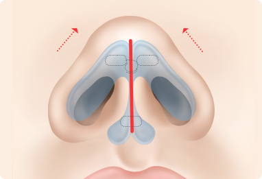 Nose Shape Correction