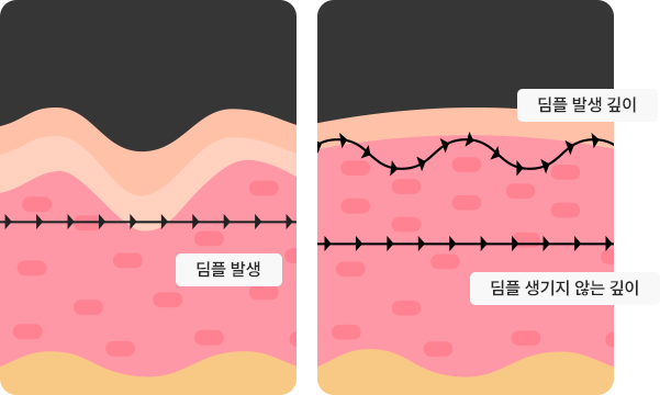 Full-Face Thread lift