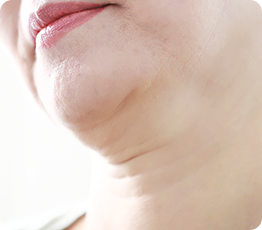 Full-Face Thread lift