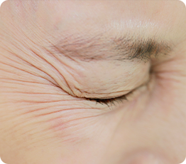 Full-Face Thread lift